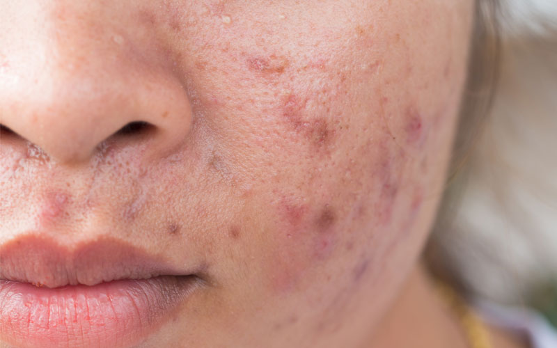 Which vitamins help fight acne?